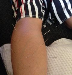 Dry Needling (Acupuncture) for the Treatment of Pain
