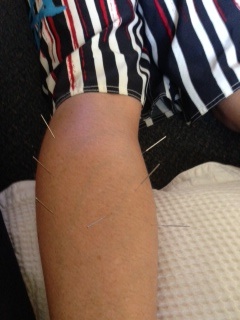 Dry Needling (Acupuncture) for the Treatment of Pain