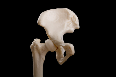 Trochanteric Bursitis – A Pain in the Hip?