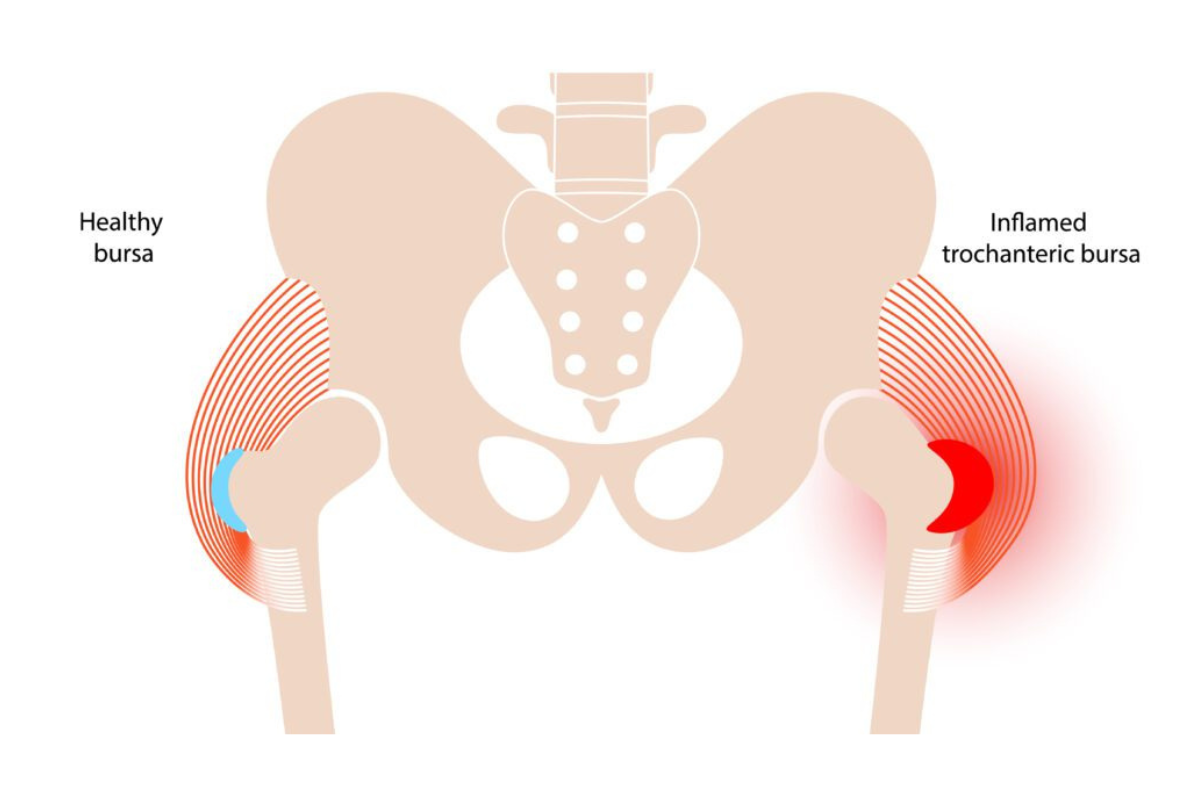 https://innovations.physio/wp-content/uploads/2023/02/Trochanteric-Bursitis-Blog-Image.png